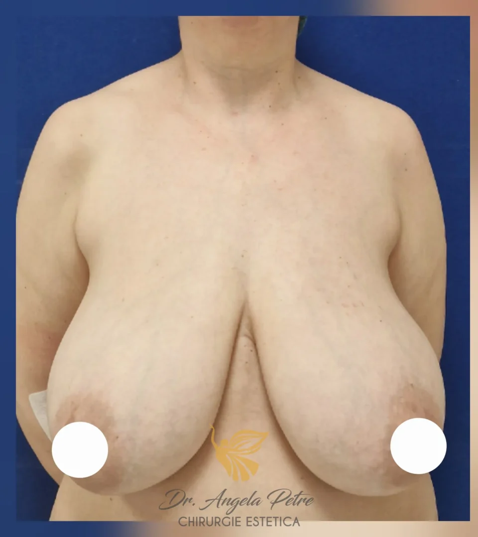 Caz 14 Reducție mamară (micșorare sâni), frontal, before, Dr. Angela Petre - București