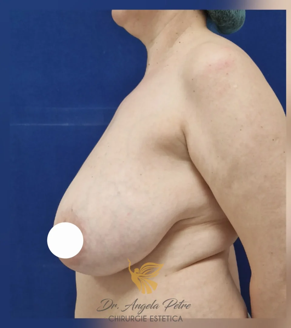 Caz 14 Reducție mamară (micșorare sâni), profil, before, Dr. Angela Petre - București