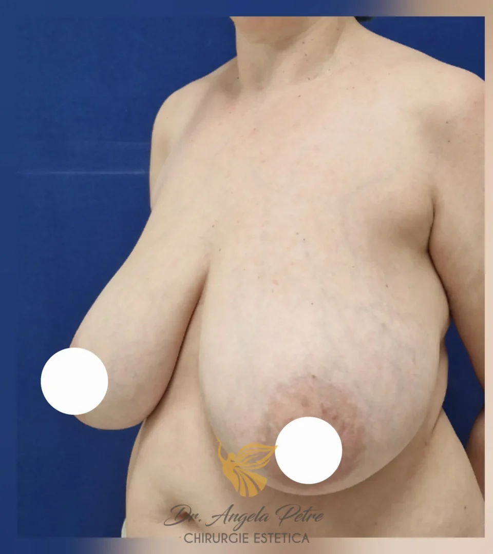 Caz 14 Reducție mamară (micșorare sâni), semiprofil, before, Dr. Angela Petre - București