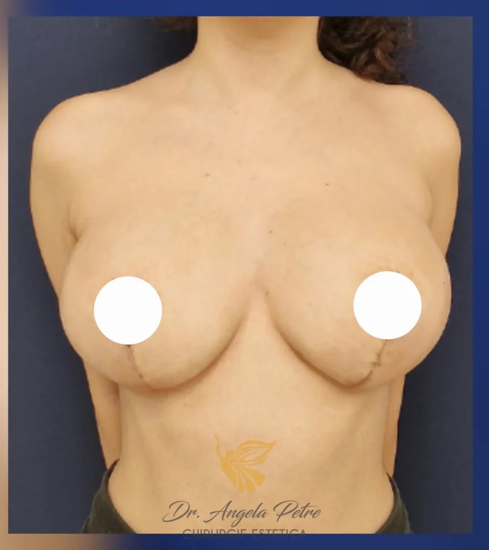 Caz 15 Reducție mamară (micșorare sâni), frontal, after, Dr. Angela Petre - București
