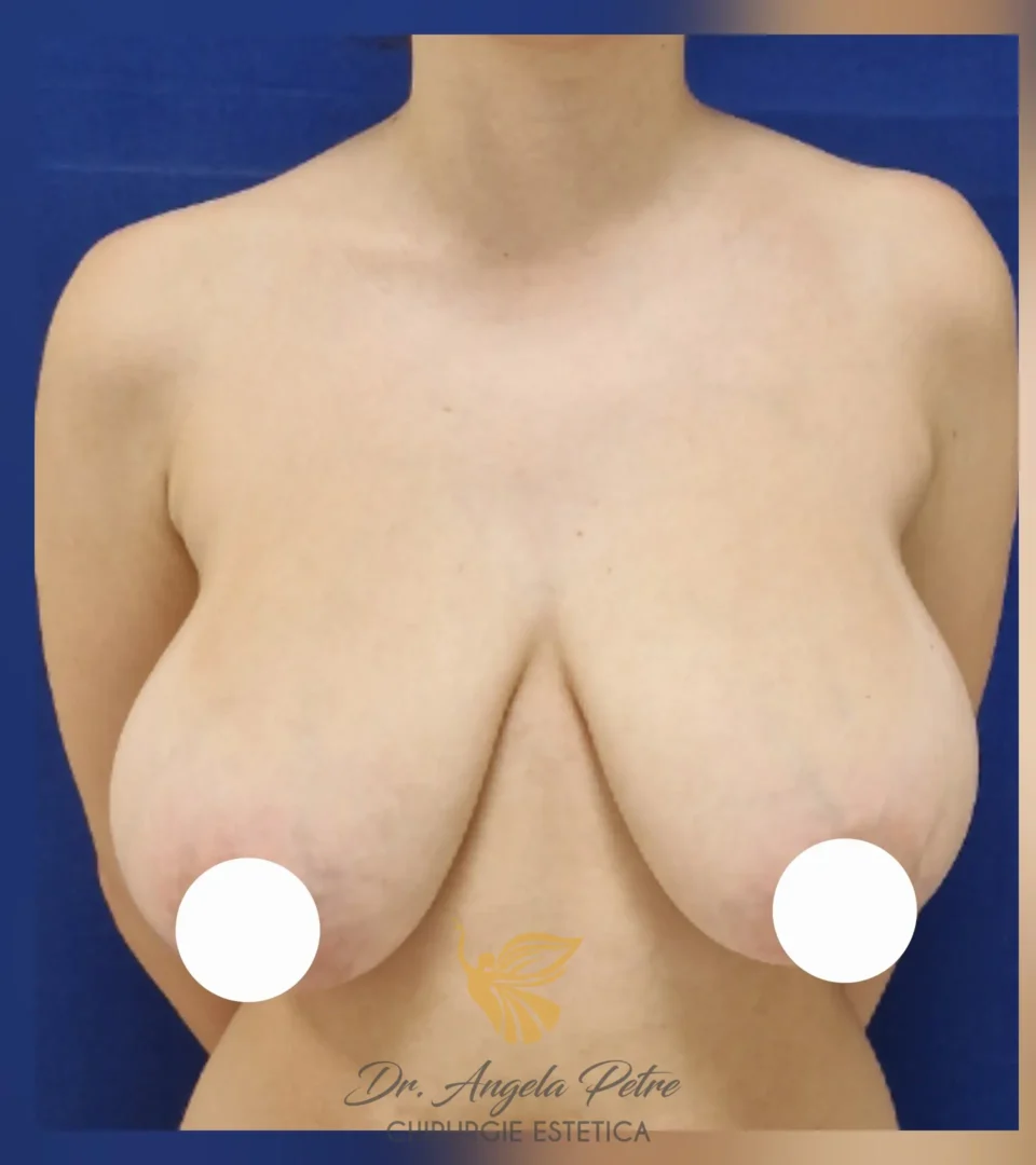 Caz 15 Reducție mamară (micșorare sâni), frontal, before, Dr. Angela Petre - București