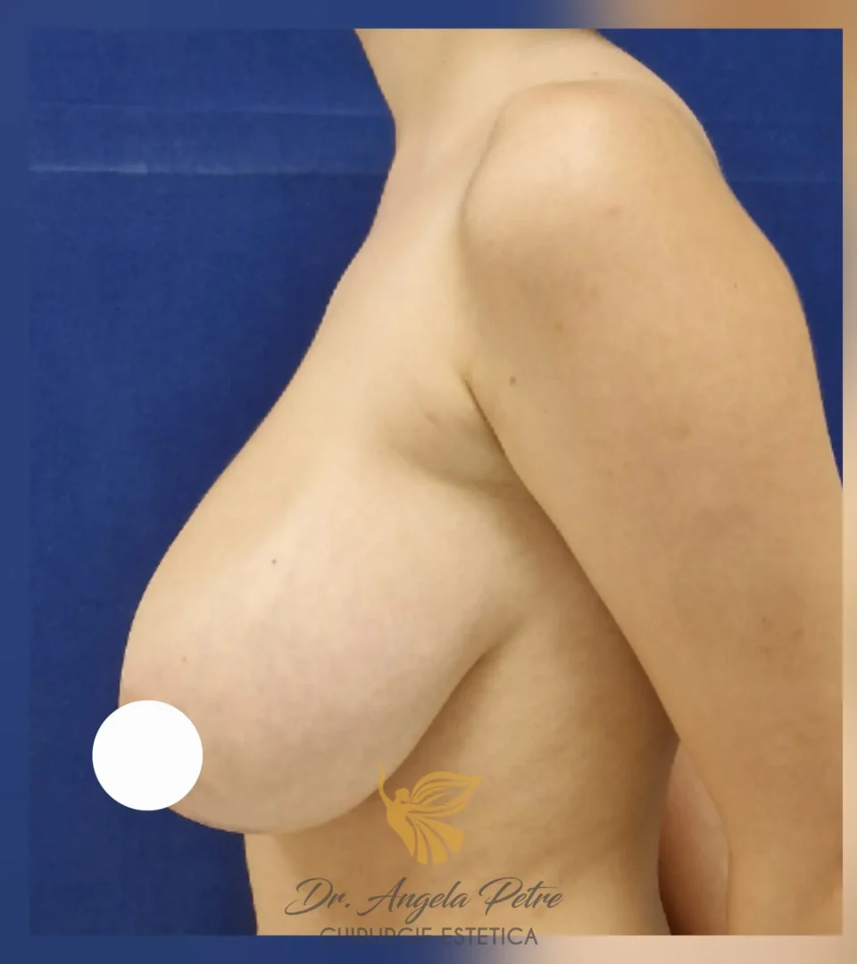Caz 15 Reducție mamară (micșorare sâni), profil, before, Dr. Angela Petre - București