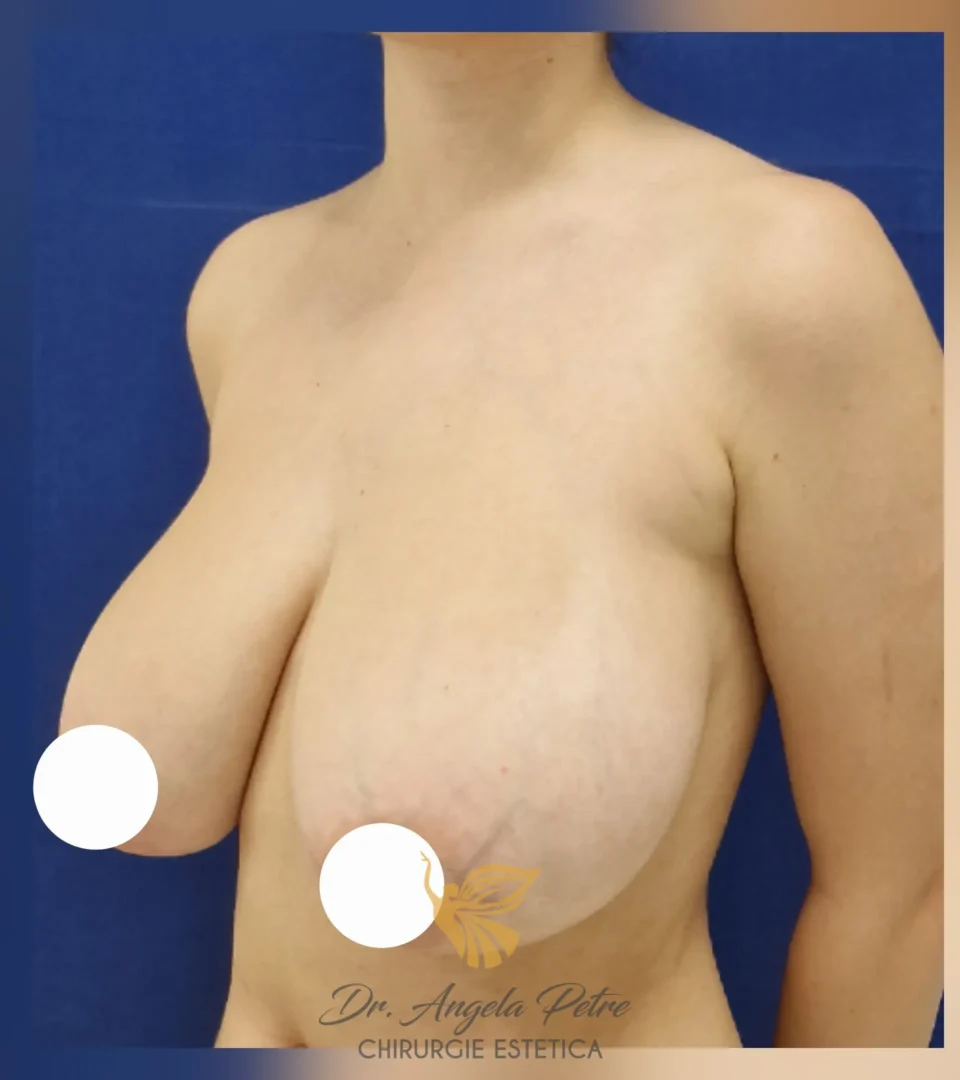 Caz 15 Reducție mamară (micșorare sâni), semiprofil, before, Dr. Angela Petre - București