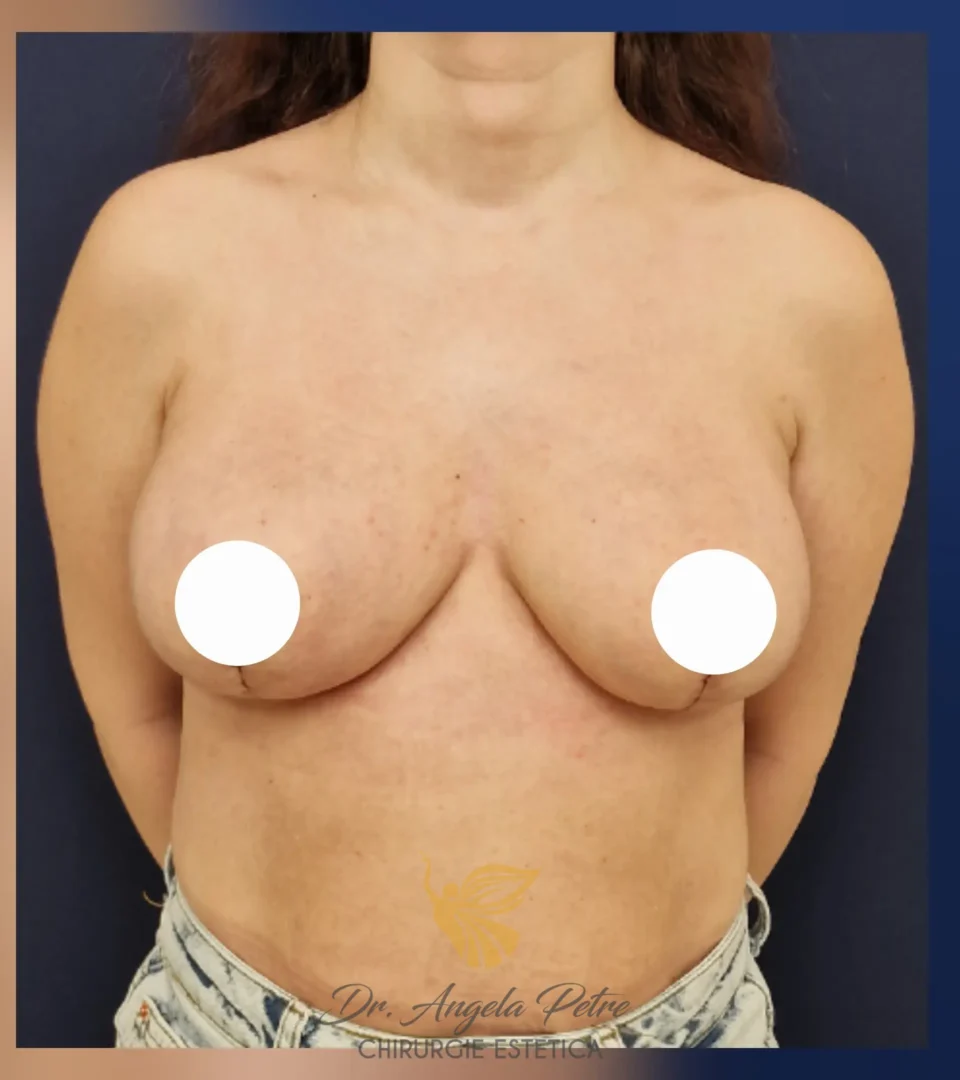 Caz 16 Reducție mamară (micșorare sâni), frontal, after, Dr. Angela Petre - București