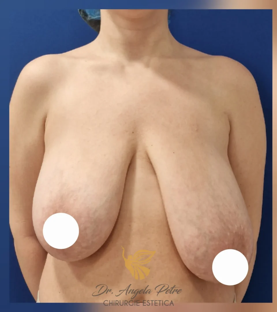Caz 16 Reducție mamară (micșorare sâni), frontal, before, Dr. Angela Petre - București