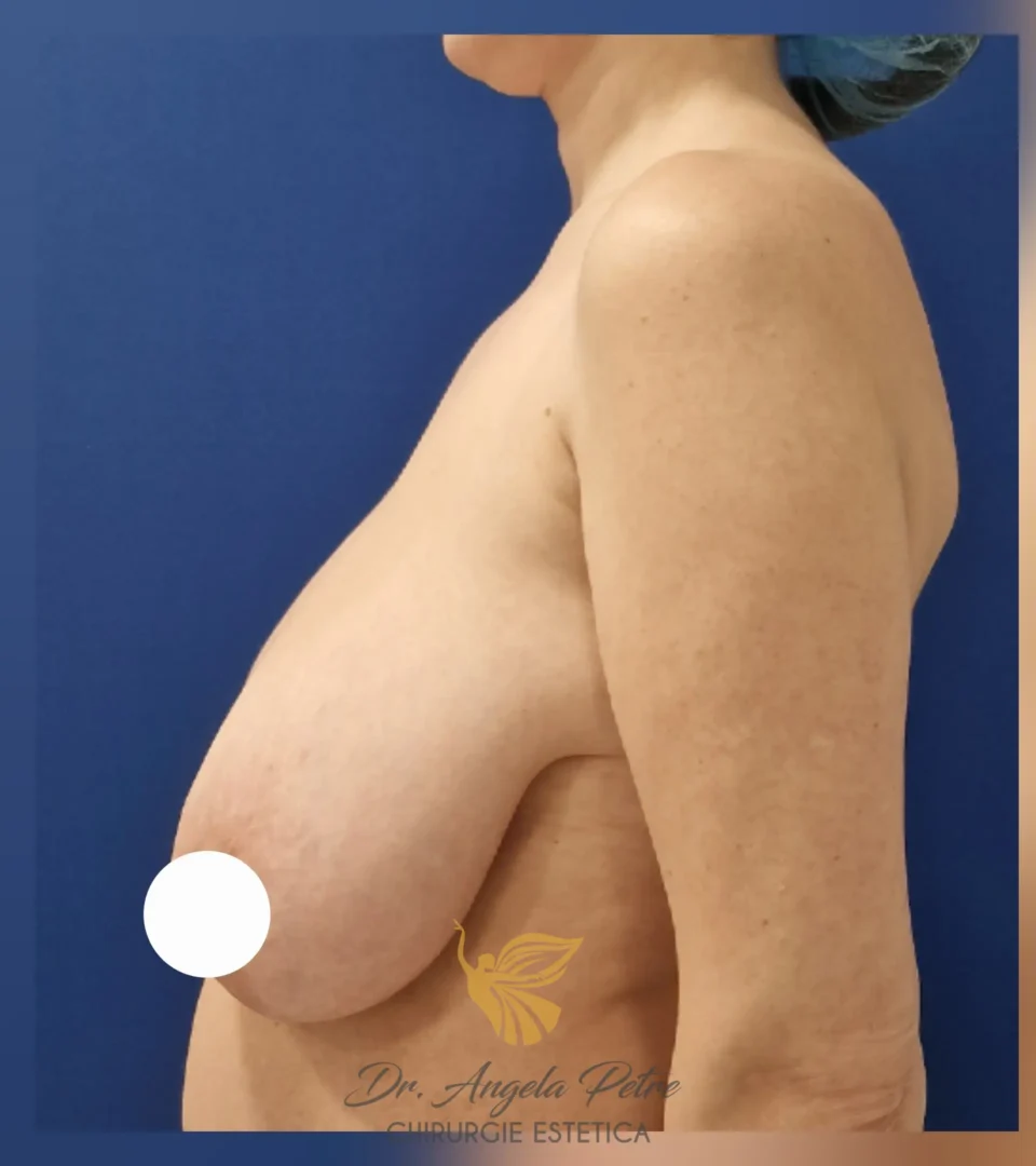 Caz 16 Reducție mamară (micșorare sâni), profil, before, Dr. Angela Petre - București
