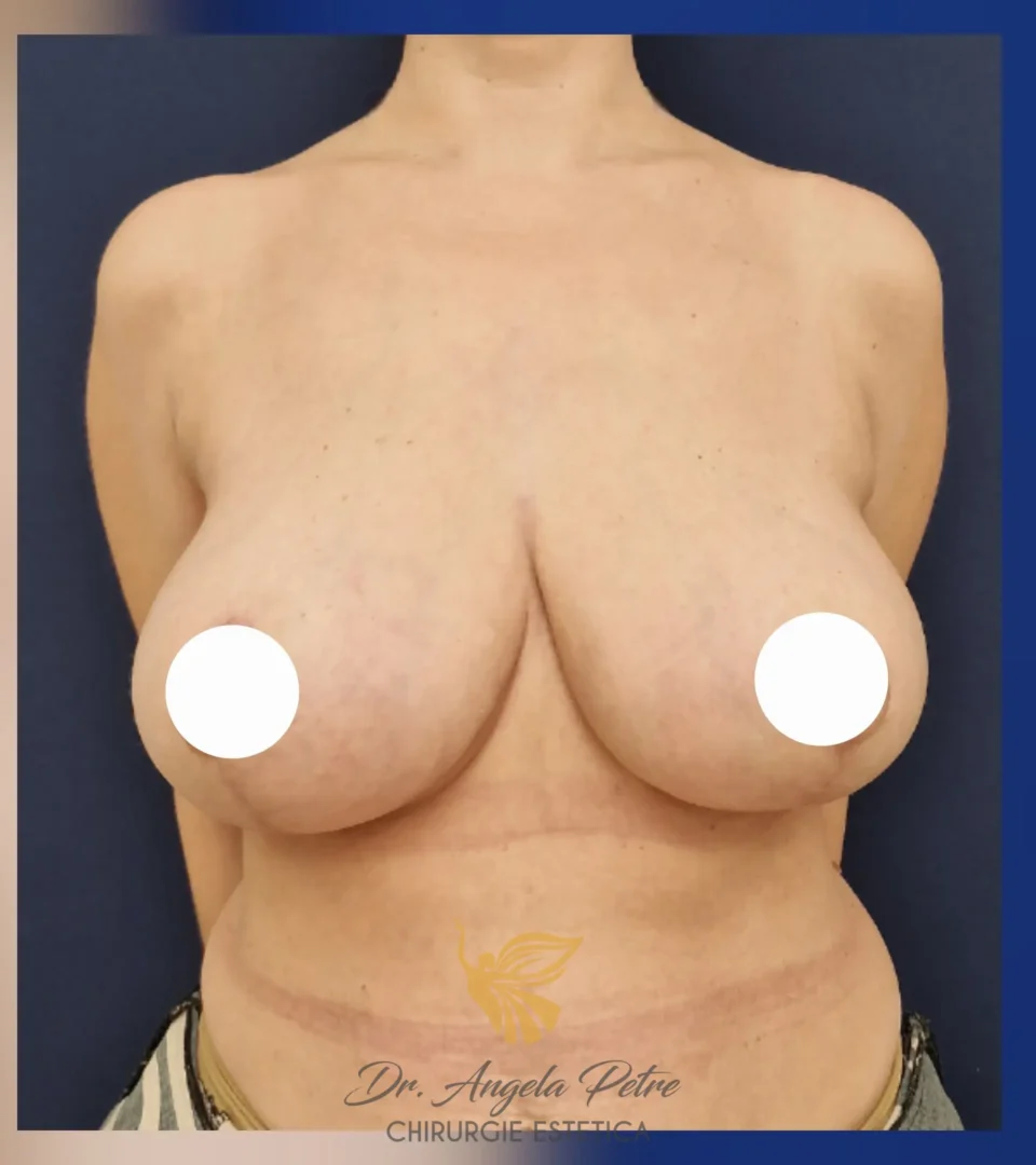 Caz 17 Reducție mamară (micșorare sâni), frontal, after, Dr. Angela Petre - București