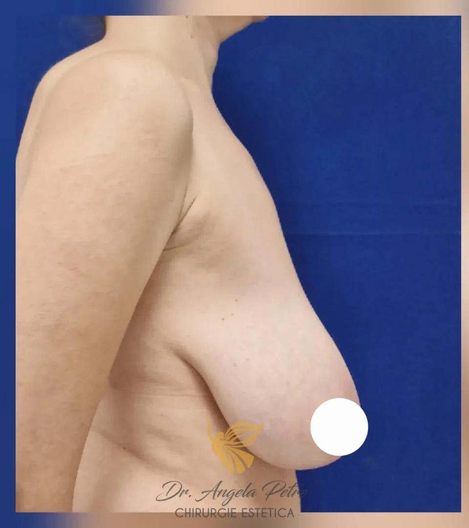 Caz 17 Reducție mamară (micșorare sâni), profil, before, Dr. Angela Petre - București