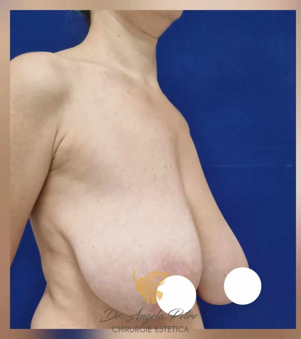 Caz 17 Reducție mamară (micșorare sâni), semiprofil, before, Dr. Angela Petre - București