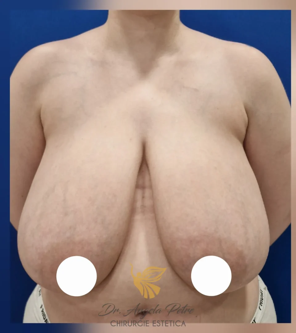 Caz 18 Reducție mamară (micșorare sâni), frontal, before, Dr. Angela Petre - București