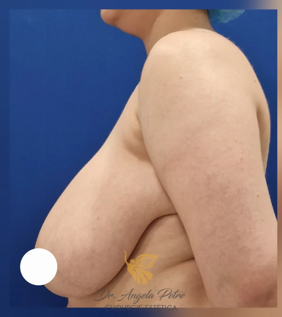 Caz 18 Reducție mamară (micșorare sâni), profil, before, Dr. Angela Petre - București