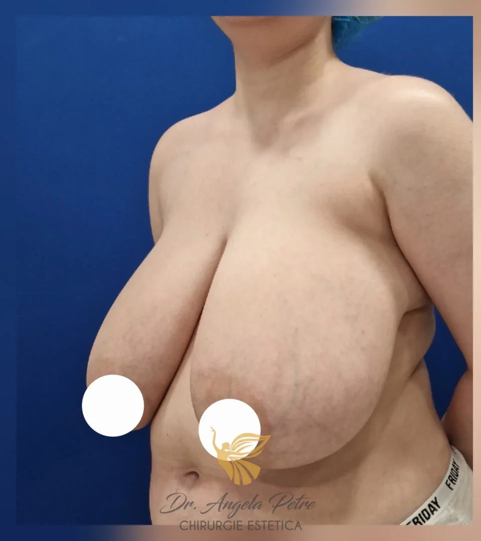 Caz 18 Reducție mamară (micșorare sâni), semiprofil, before, Dr. Angela Petre - București