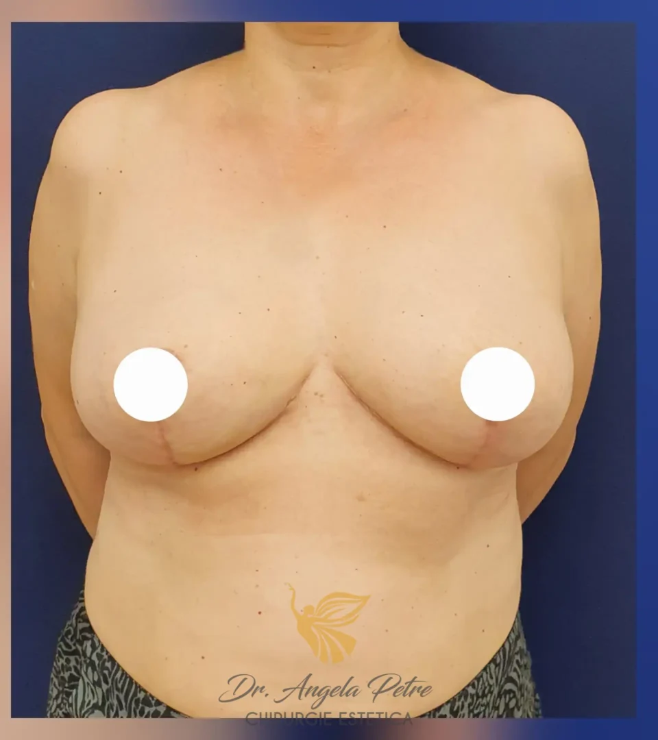 Caz 01 Reducție mamară (micșorare sâni), frontal, after, Dr. Angela Petre - București