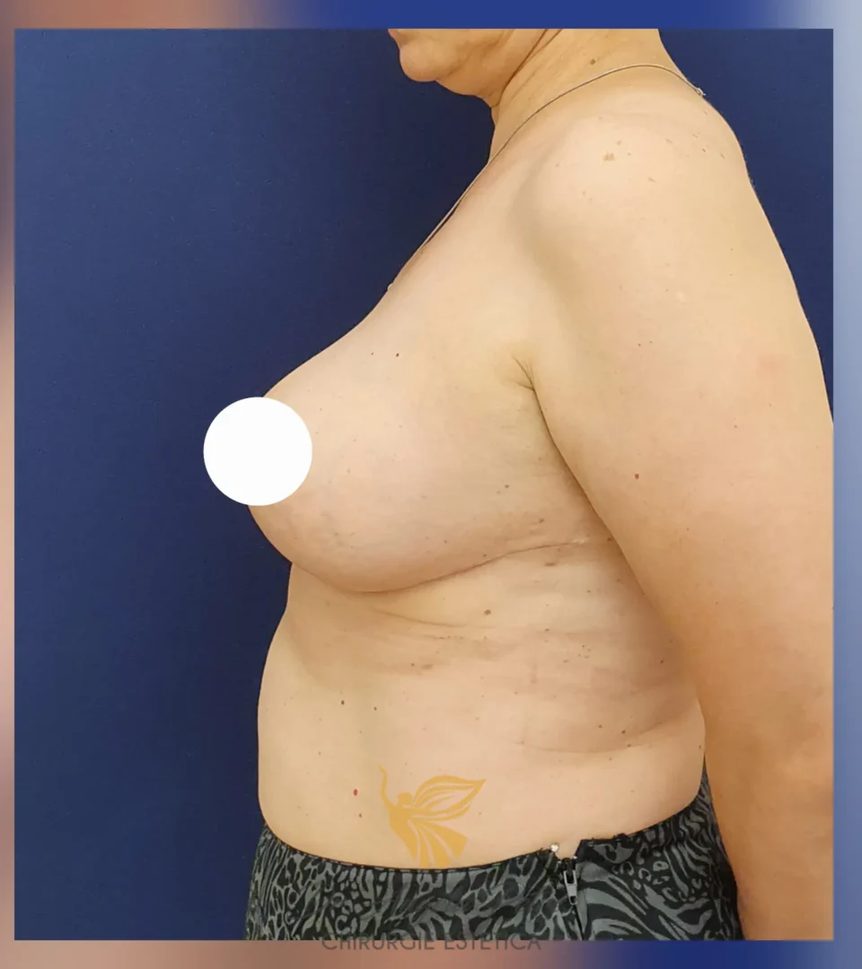 Caz 01 Reducție mamară (micșorare sâni), profil, after, Dr. Angela Petre - București