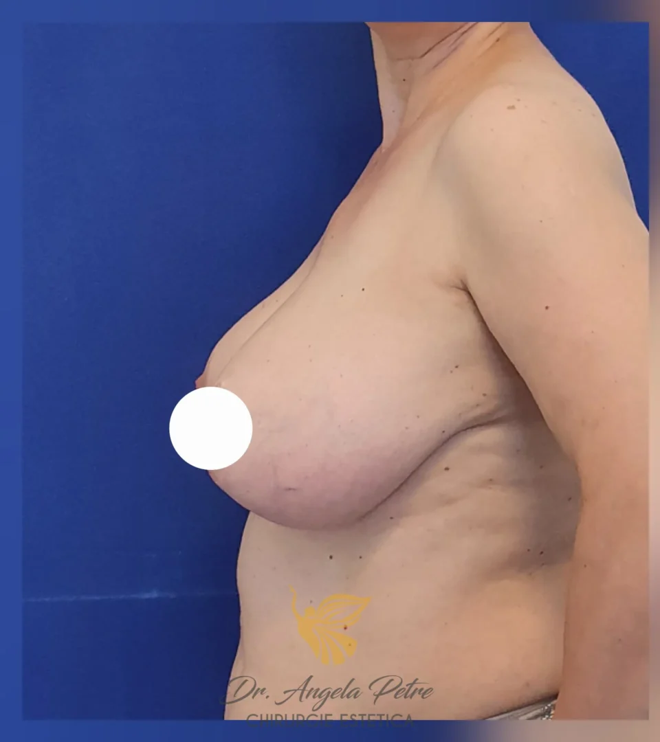 Caz 01 Reducție mamară (micșorare sâni), profil, before, Dr. Angela Petre - București