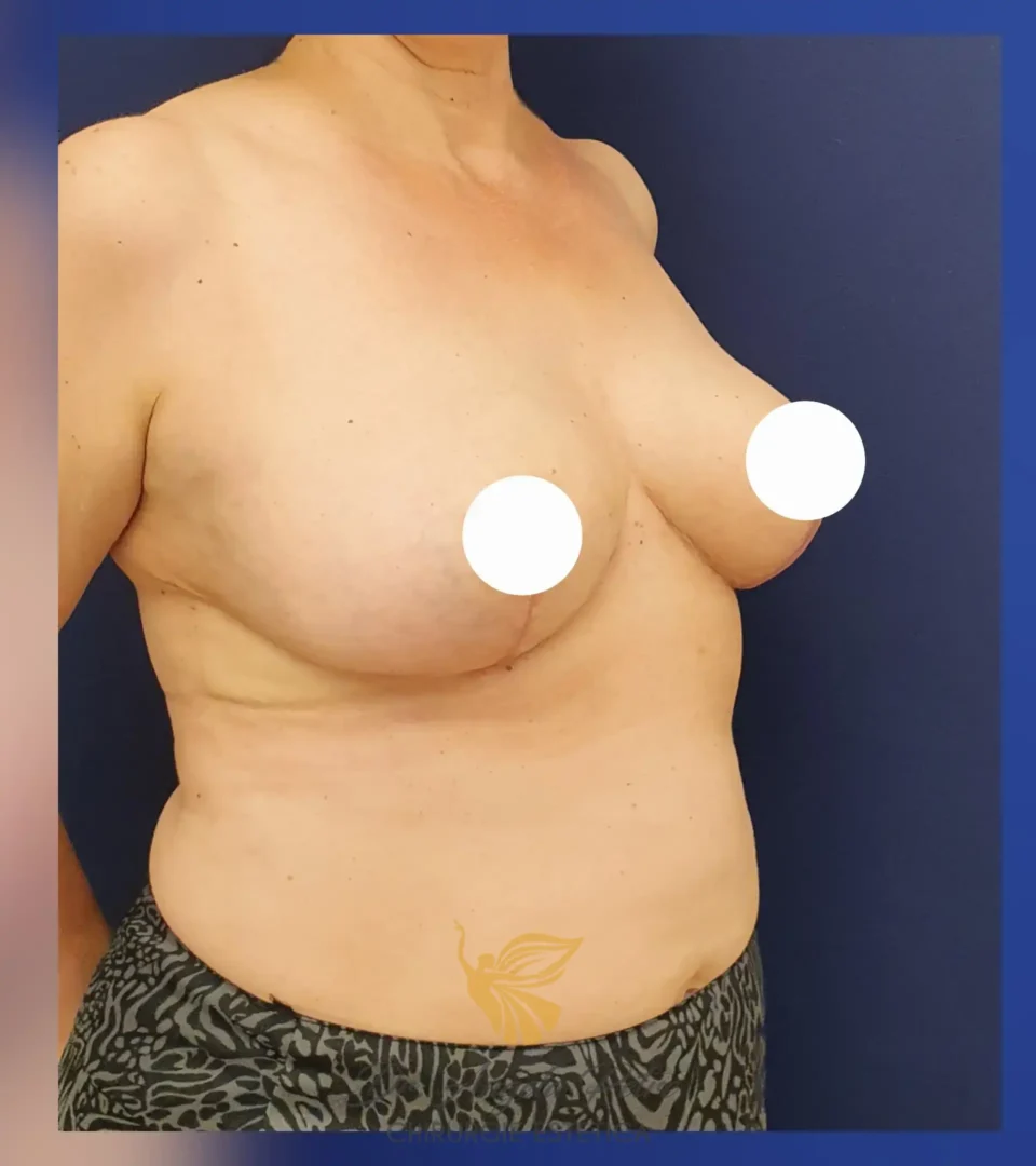 Caz 01 Reducție mamară (micșorare sâni), semiprofil, after, Dr. Angela Petre - București
