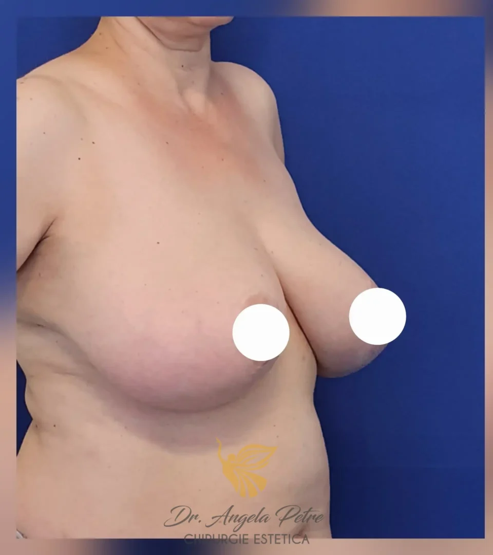 Caz 01 Reducție mamară (micșorare sâni), semiprofil, before, Dr. Angela Petre - București