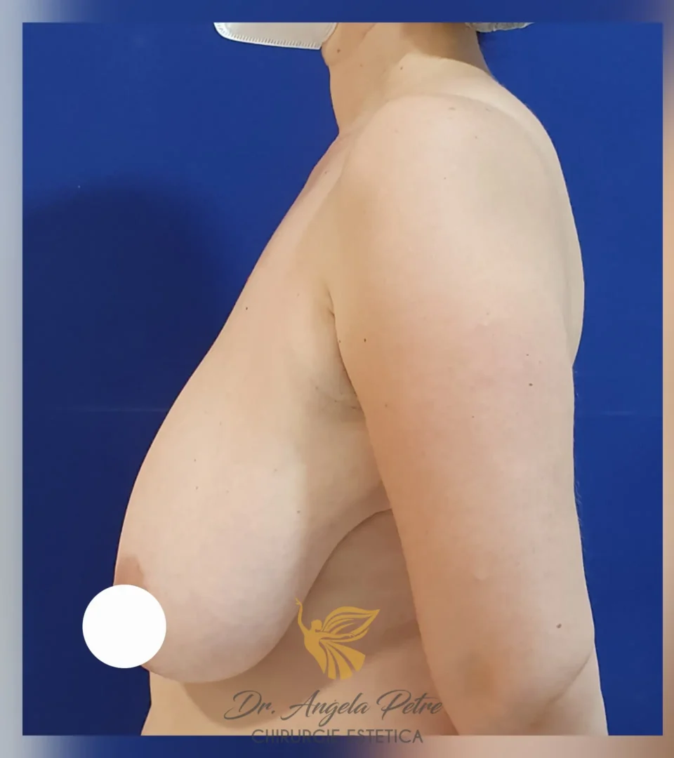 Caz 20 Reducție mamară (micșorare sâni), profil, before, Dr. Angela Petre - București