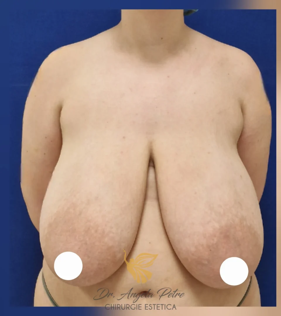 Caz 21 Reducție mamară (micșorare sâni), frontal, before, Dr. Angela Petre - București
