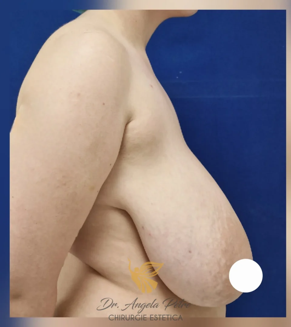 Caz 21 Reducție mamară (micșorare sâni), profil, before, Dr. Angela Petre - București