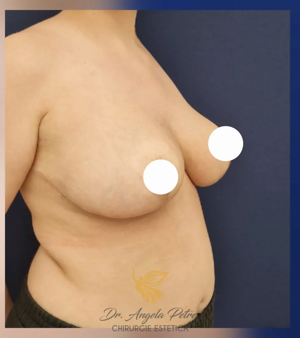 Caz 21 Reducție mamară (micșorare sâni), semiprofil, after, Dr. Angela Petre - București