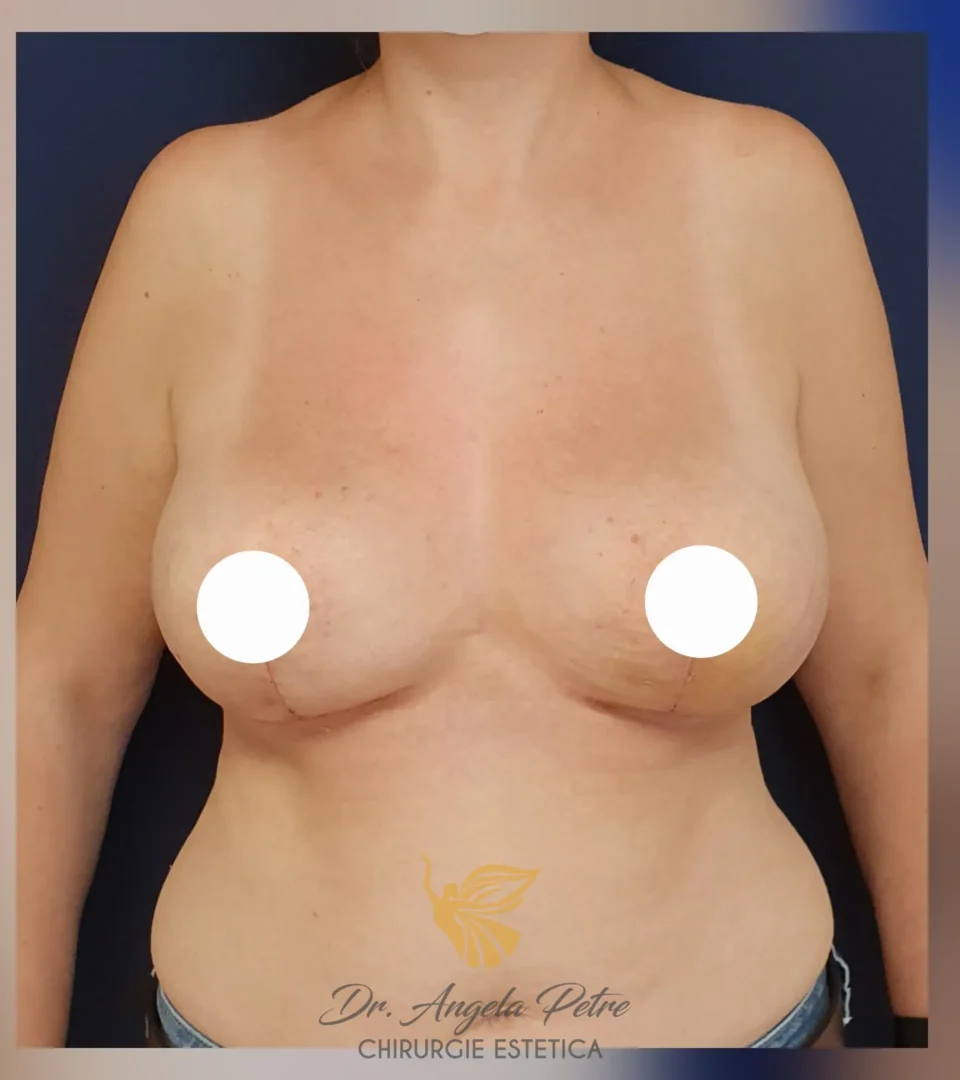 Caz 22 Reducție mamară (micșorare sâni), frontal, after, Dr. Angela Petre - București