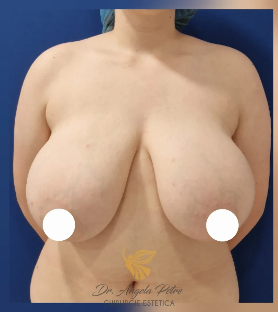 Caz 23 Reducție mamară (micșorare sâni), frontal, before, Dr. Angela Petre - București