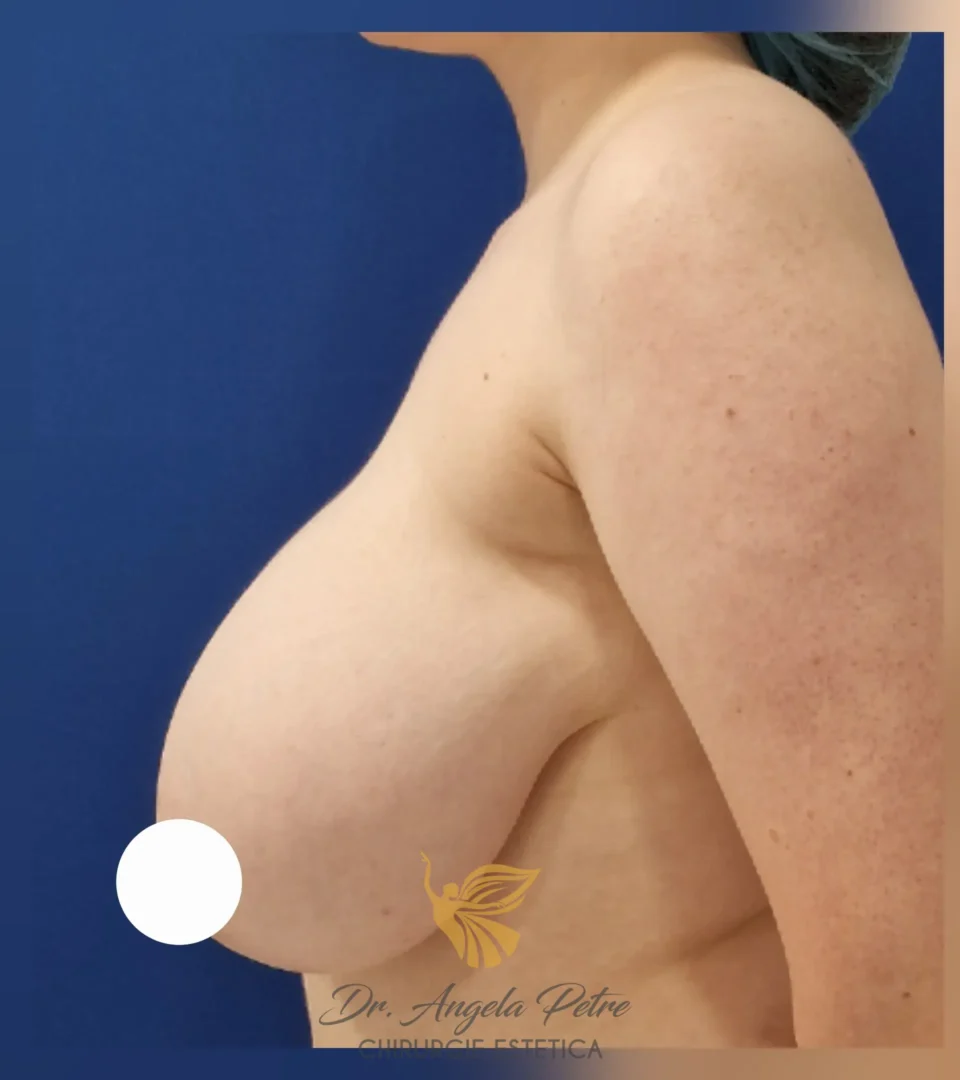 Caz 23 Reducție mamară (micșorare sâni), profil, before, Dr. Angela Petre - București