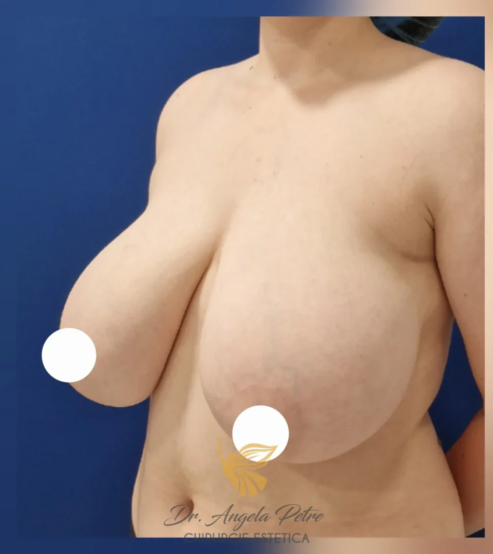 Caz 23 Reducție mamară (micșorare sâni), semiprofil, before, Dr. Angela Petre - București
