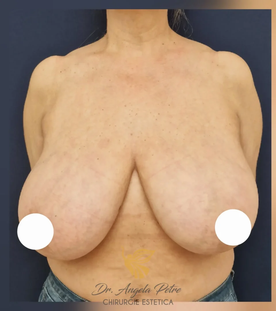 Caz 24 Reducție mamară (micșorare sâni), frontal, before, Dr. Angela Petre - București