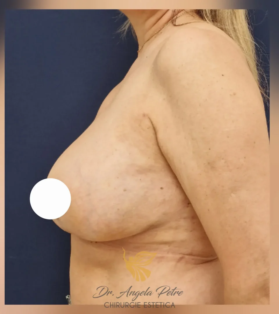 Caz 24 Reducție mamară (micșorare sâni), profil, after, Dr. Angela Petre - București