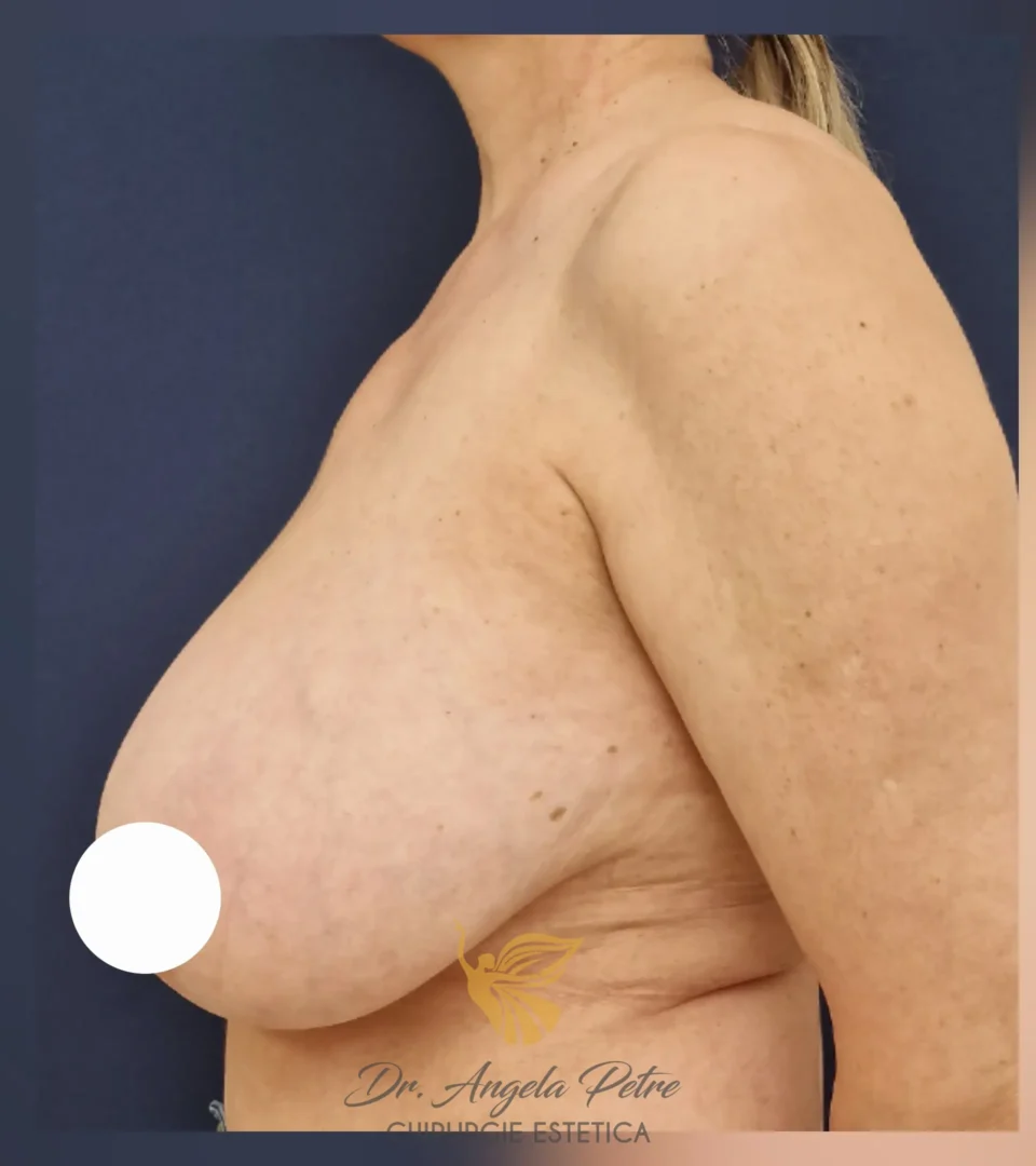 Caz 24 Reducție mamară (micșorare sâni), profil, before, Dr. Angela Petre - București