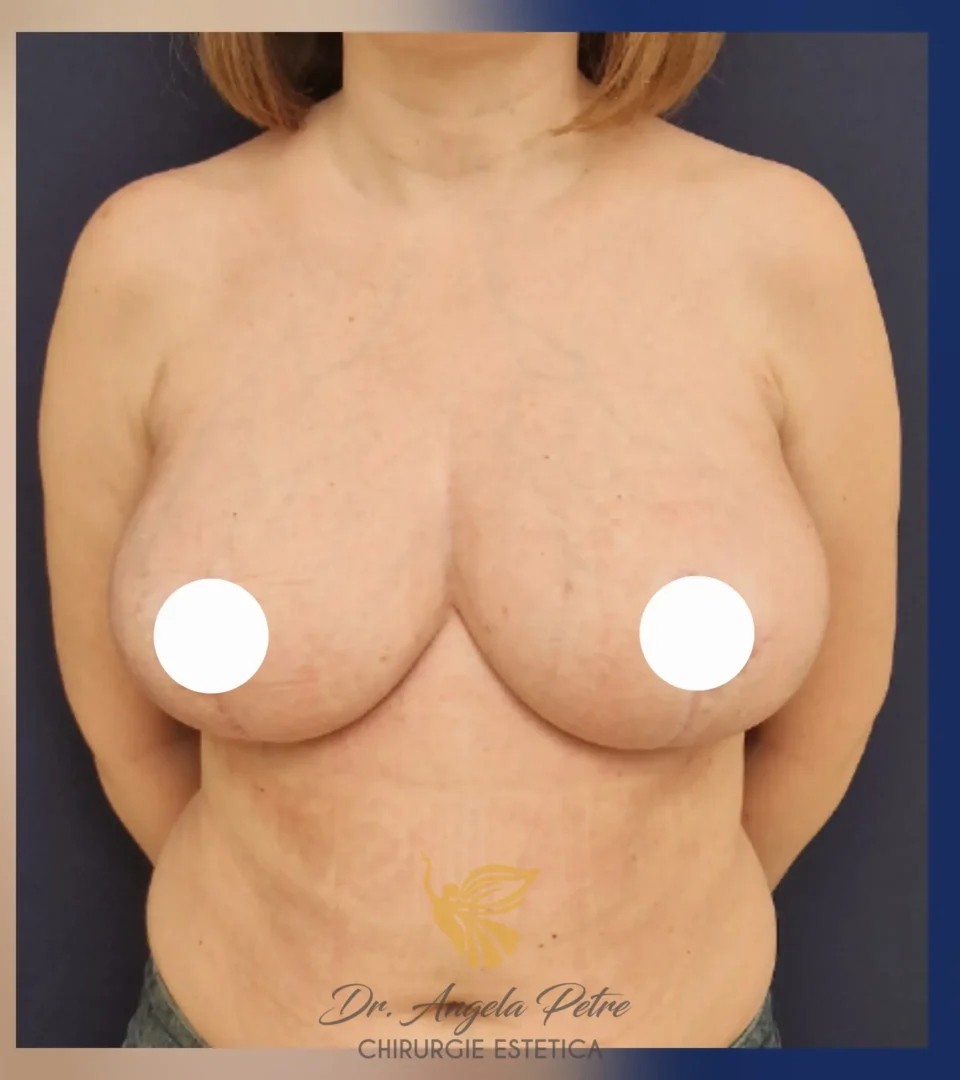 Caz 25 Reducție mamară (micșorare sâni), frontal, after, Dr. Angela Petre - București