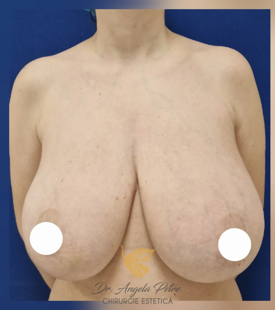 Caz 25 Reducție mamară (micșorare sâni), frontal, before, Dr. Angela Petre - București