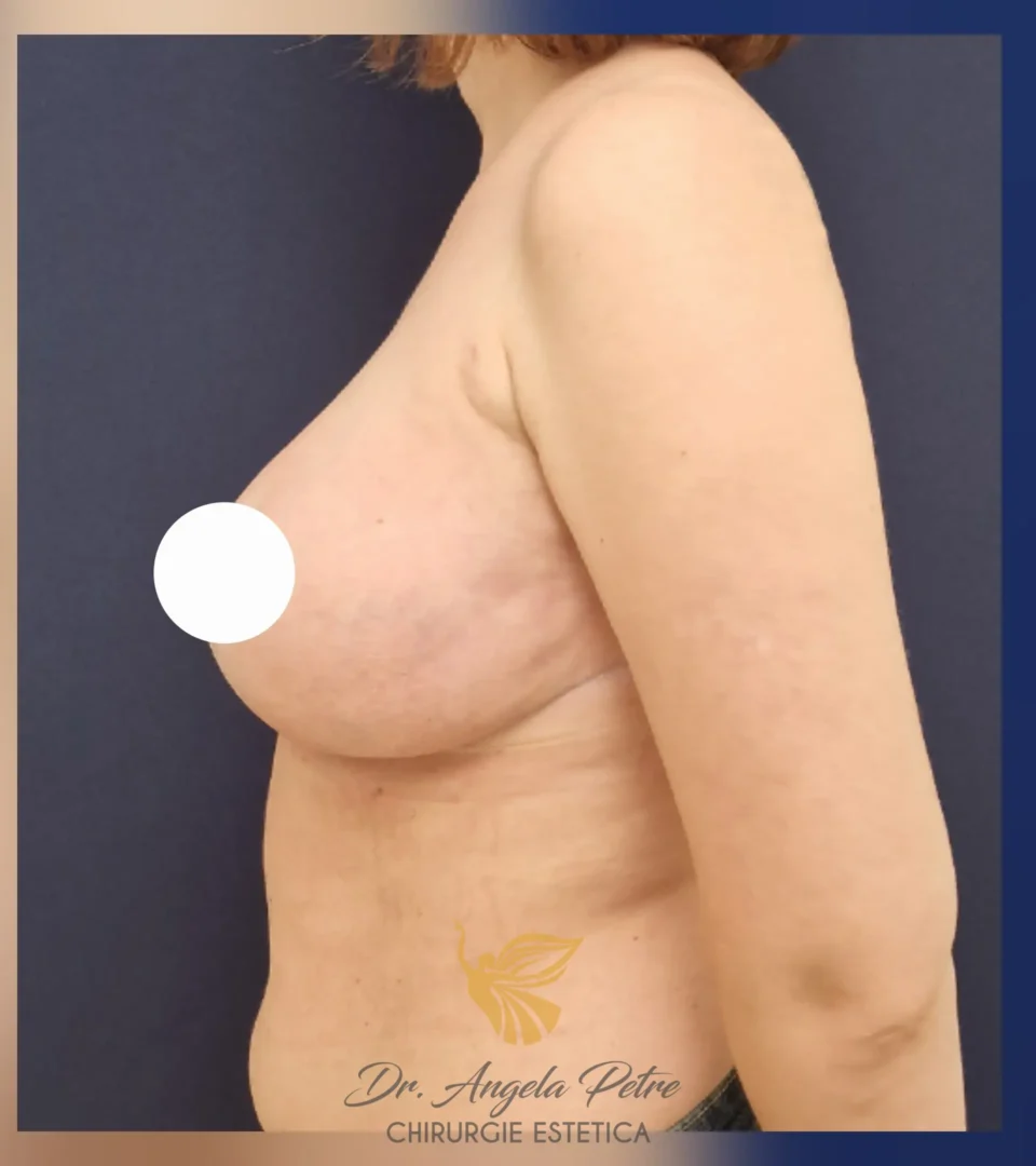 Caz 25 Reducție mamară (micșorare sâni), profil, after, Dr. Angela Petre - București