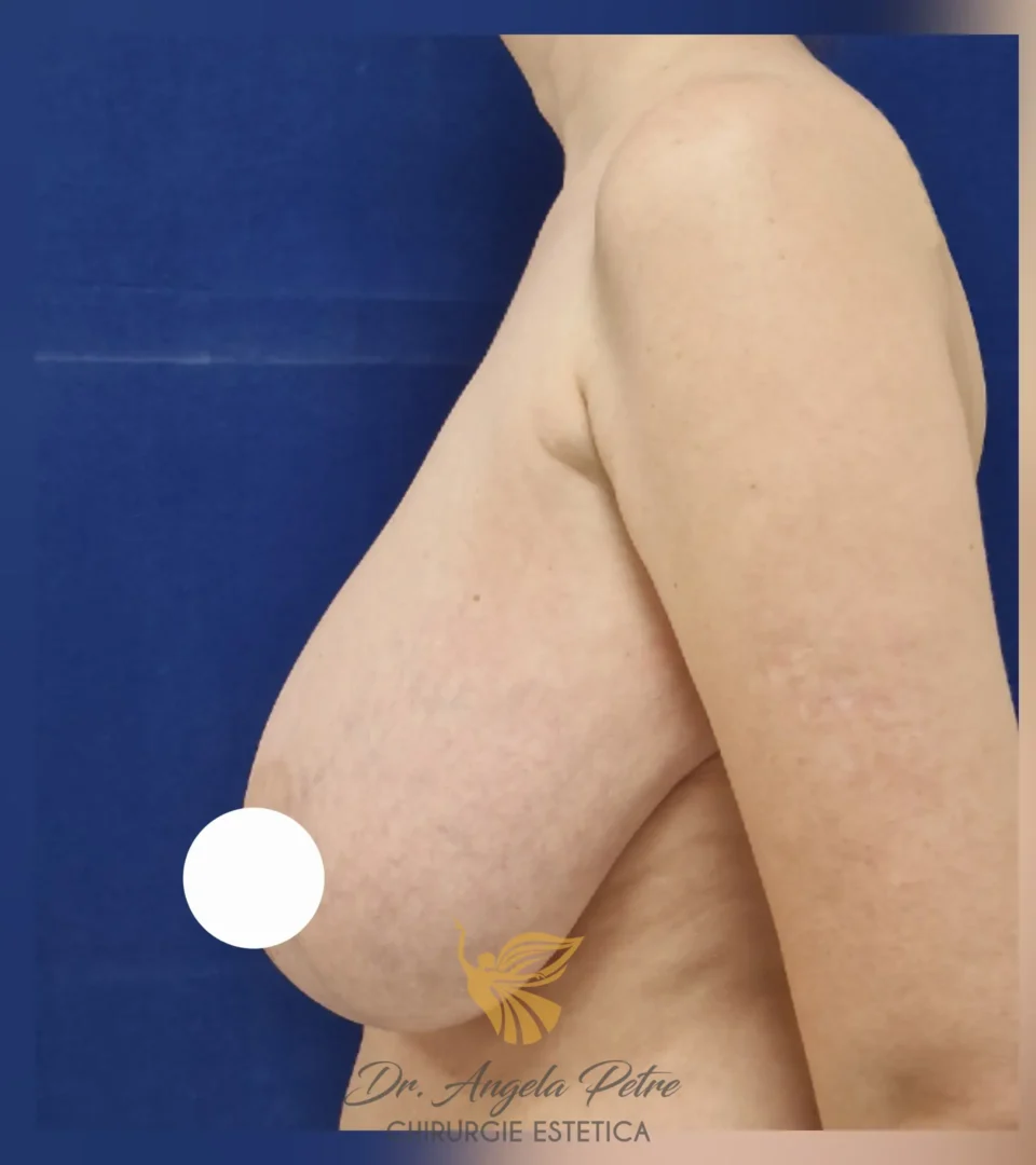 Caz 25 Reducție mamară (micșorare sâni), profil, before, Dr. Angela Petre - București