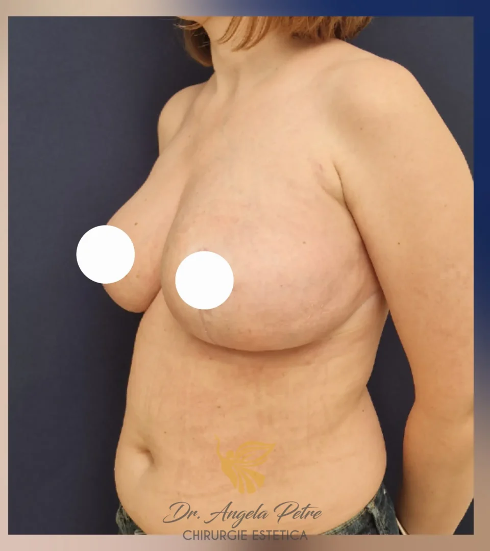 Caz 25 Reducție mamară (micșorare sâni), semiprofil, after, Dr. Angela Petre - București