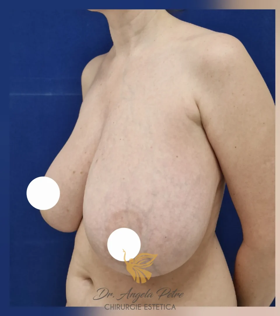 Caz 25 Reducție mamară (micșorare sâni), semiprofil, before, Dr. Angela Petre - București