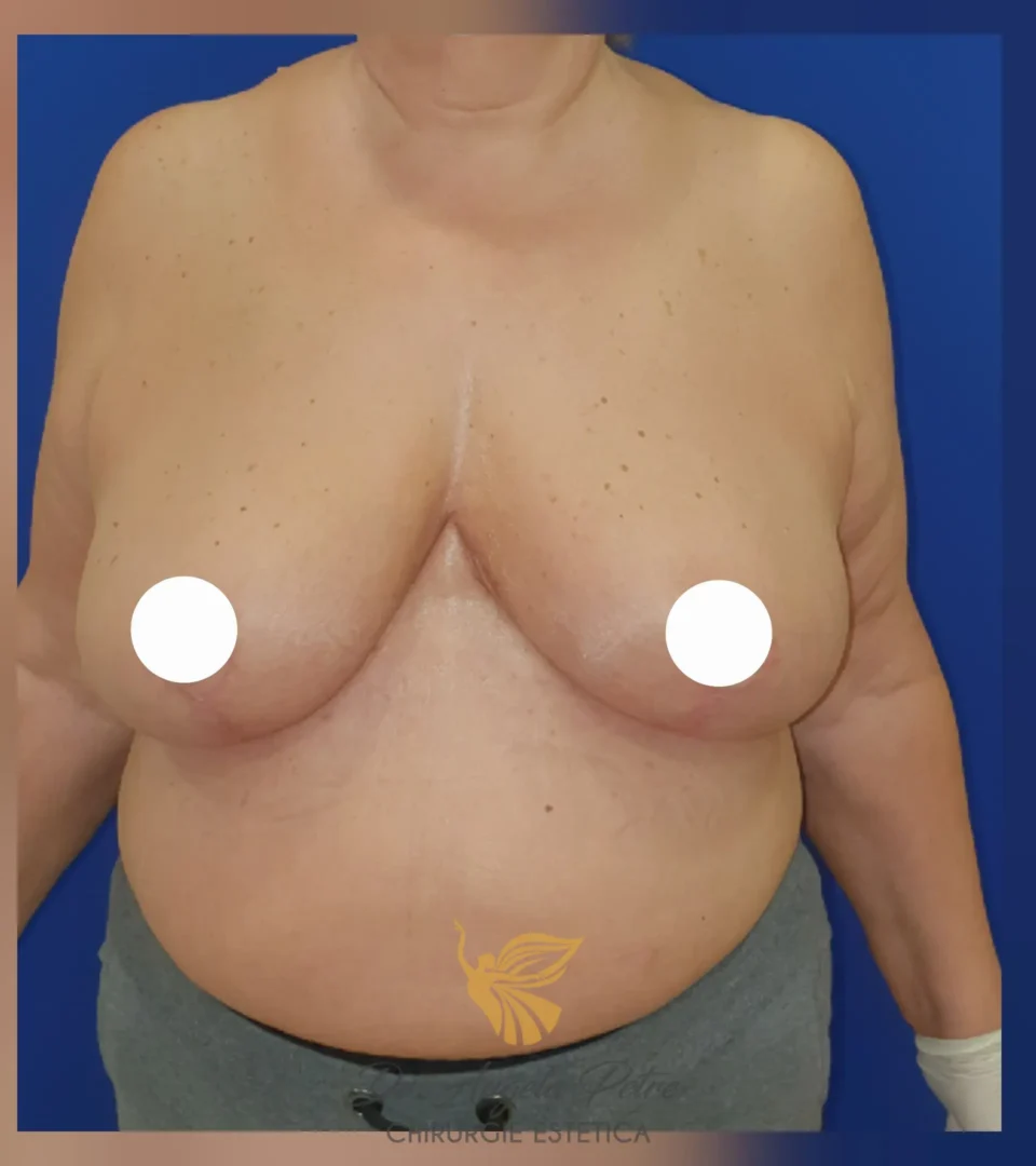Caz 02 Reducție mamară (micșorare sâni), frontal, after, Dr. Angela Petre - București