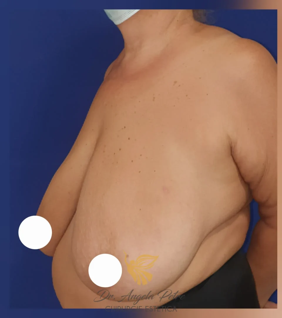 Caz 02 Reducție mamară (micșorare sâni), semiprofil, before, Dr. Angela Petre - București