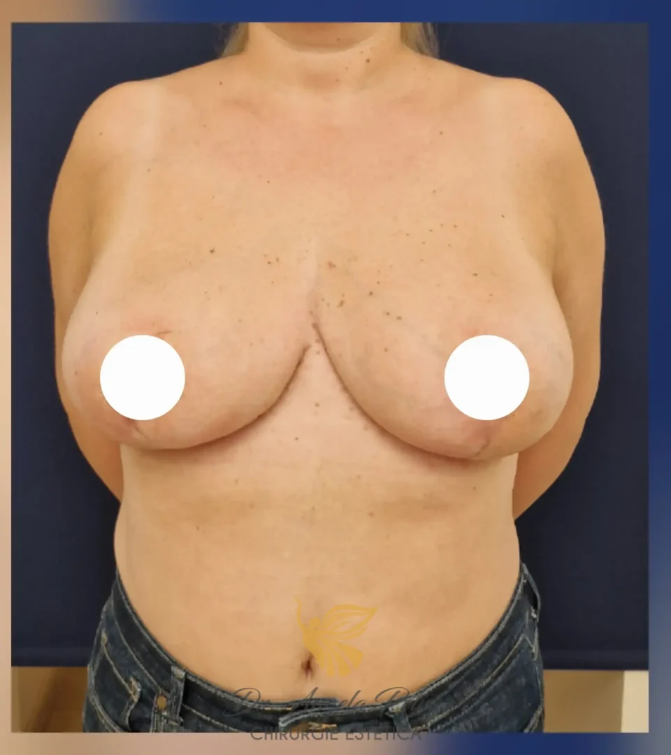 Caz 03 Reducție mamară (micșorare sâni), frontal, after, Dr. Angela Petre - București