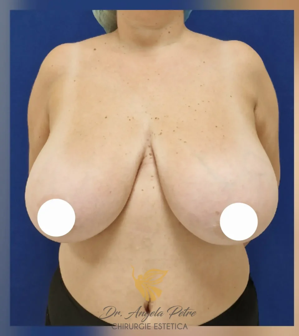 Caz 03 Reducție mamară (micșorare sâni), frontal, before, Dr. Angela Petre - București