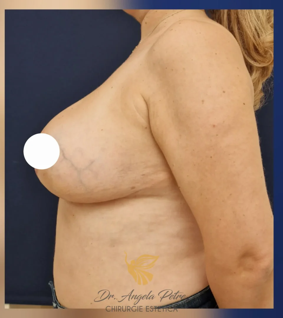 Caz 03 Reducție mamară (micșorare sâni), profil, after, Dr. Angela Petre - București
