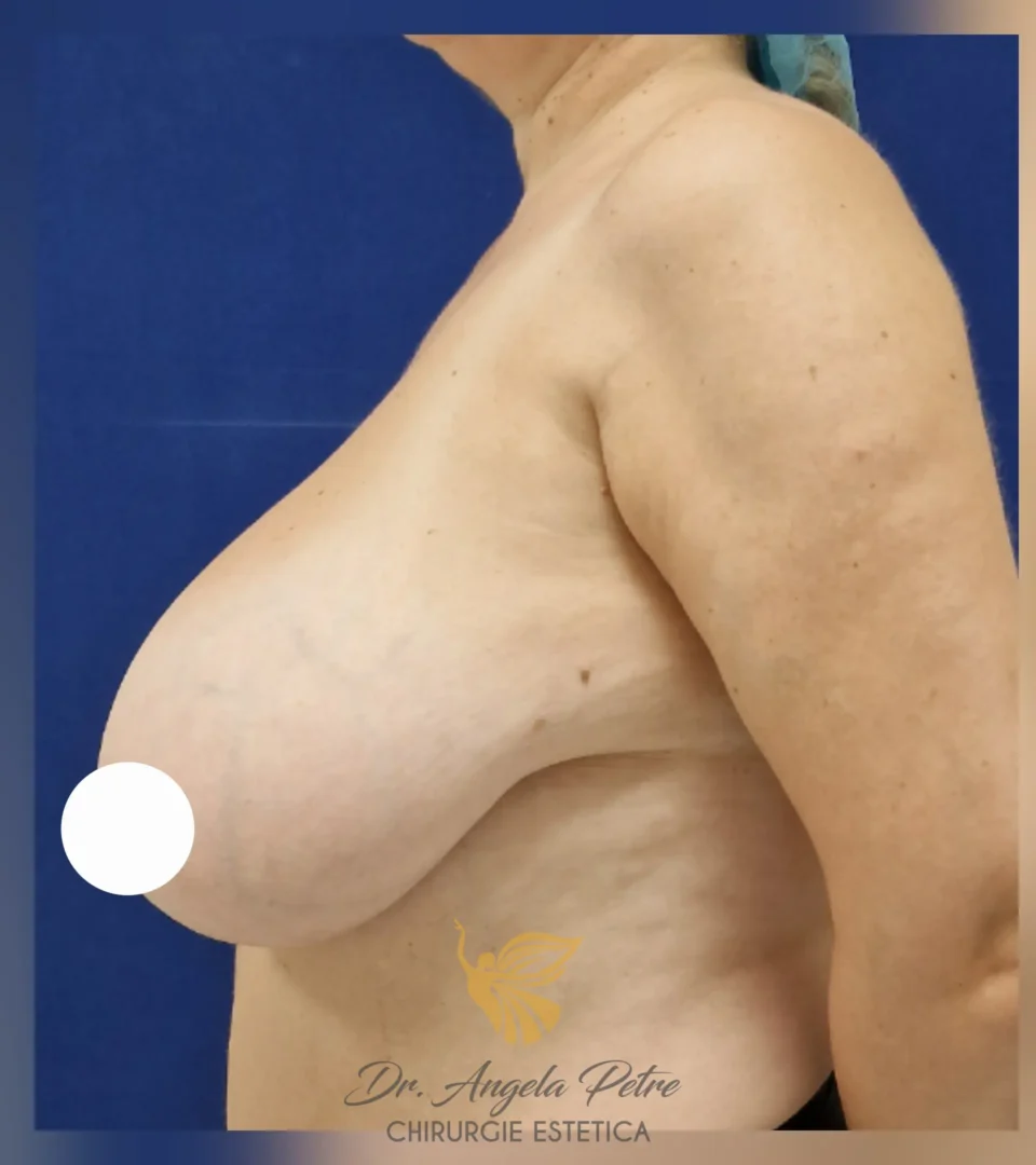 Caz 03 Reducție mamară (micșorare sâni), profil, before, Dr. Angela Petre - București