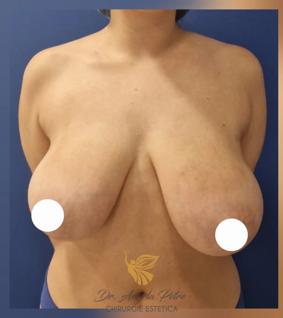 Caz 04 Reducție mamară (micșorare sâni), frontal, before, Dr. Angela Petre - București