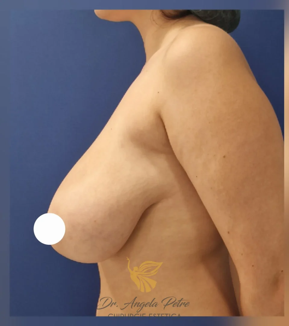 Caz 04 Reducție mamară (micșorare sâni), profil, before, Dr. Angela Petre - București