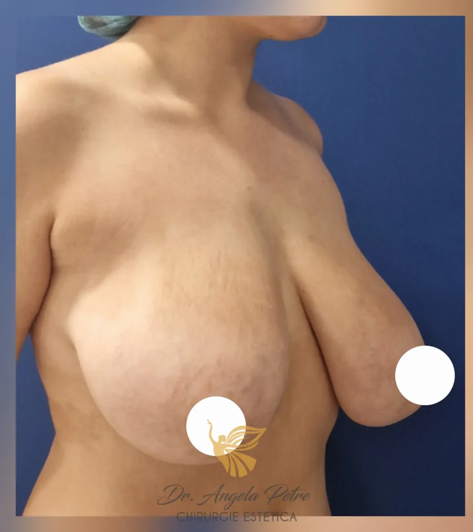 Caz 04 Reducție mamară (micșorare sâni), semiprofil, before, Dr. Angela Petre - București