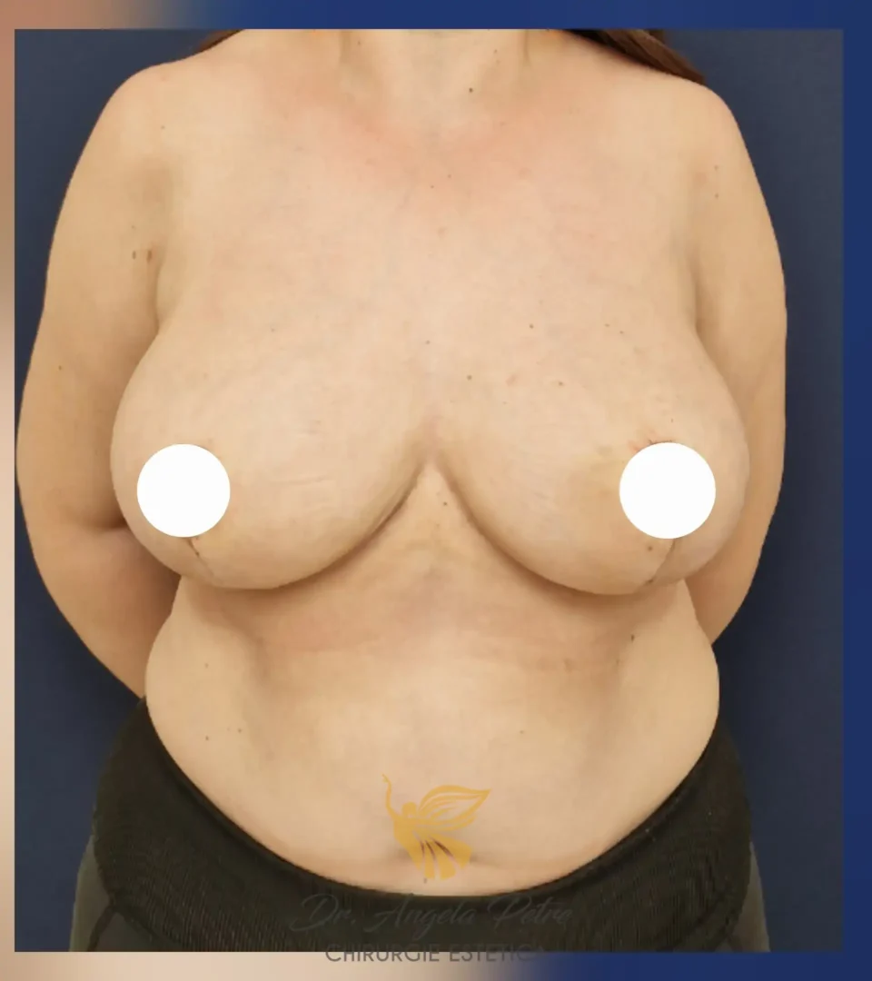 Caz 05 Reducție mamară (micșorare sâni), frontal, after, Dr. Angela Petre - București