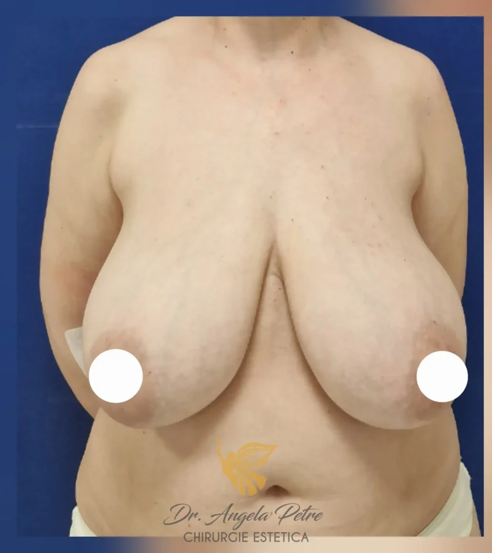 Caz 05 Reducție mamară (micșorare sâni), frontal, before, Dr. Angela Petre - București