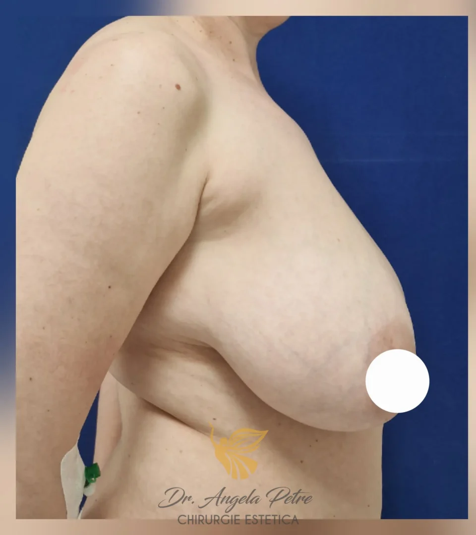 Caz 05 Reducție mamară (micșorare sâni), profil, before, Dr. Angela Petre - București